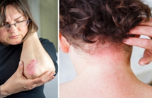 نصائح لتخفيف أعراض الإكزيما والصدفية في الشتاء