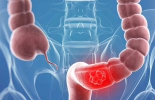 سرطان القولون.. أعراض ظاهرة لا تتجاهلها وأسباب الإصابة