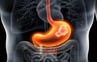 5 علامات لسرطان القولون تظهر على الجلد