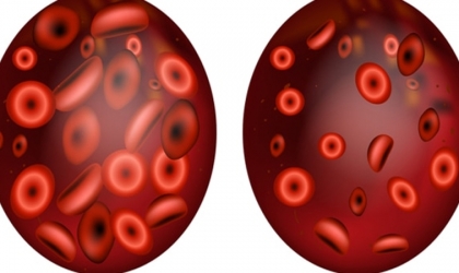 كل ما تحتاج معرفته عن مرض فقر الدم المنجلي